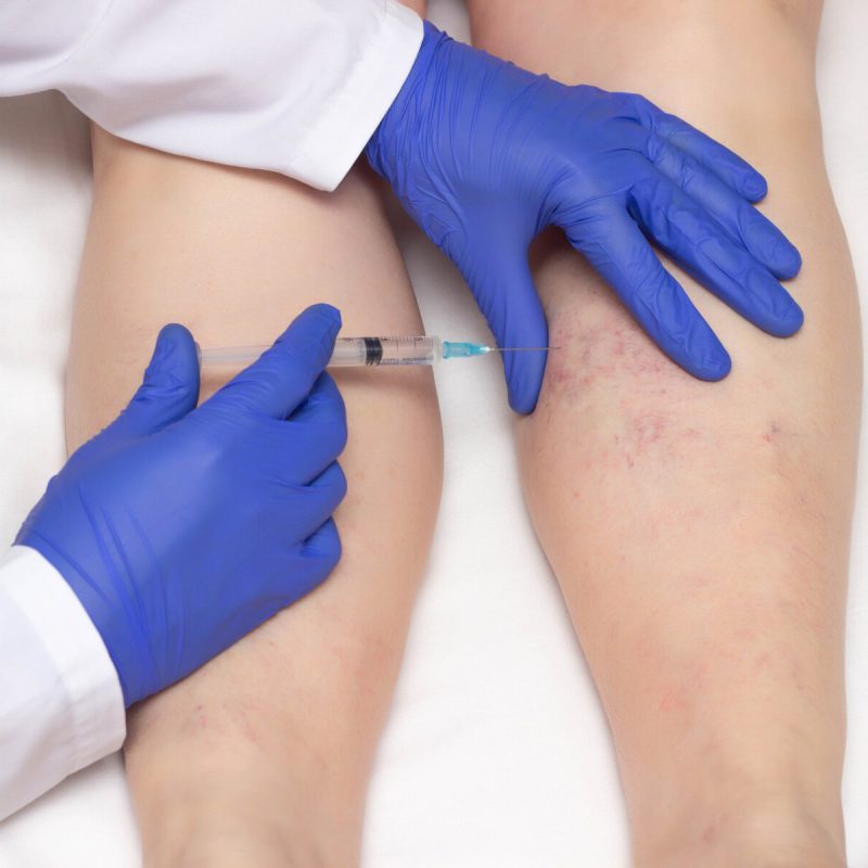 Doctor in medical gloves injects sclerotherapy procedure on the legs of a woman against varicose veins, close-up, ozone therapy