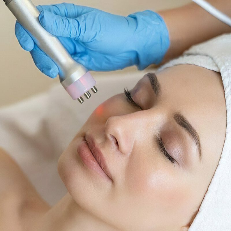 treatment-fotofacial